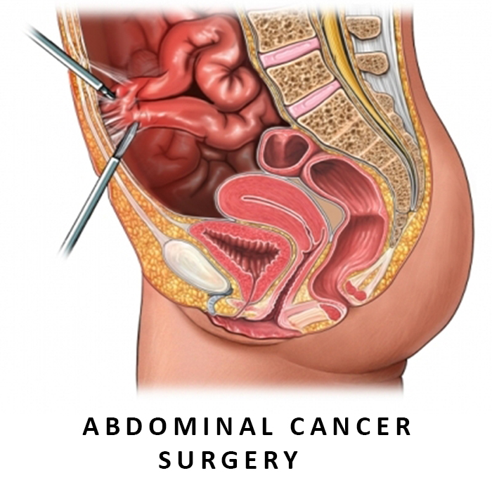 Abdominal Cancer Surgery in Ahmedabad, Gujarat