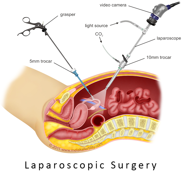 Laparoscopic Surgery in Ahmedabad, Gujarat