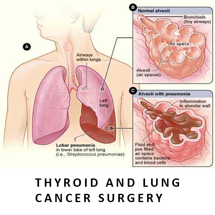 Thyroid and Lung Cancer Surgery in Ahmedabad, Gujarat