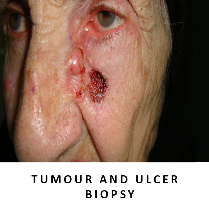 Tumour and Ulcer Biopsy in Ahmedabad, Gujarat