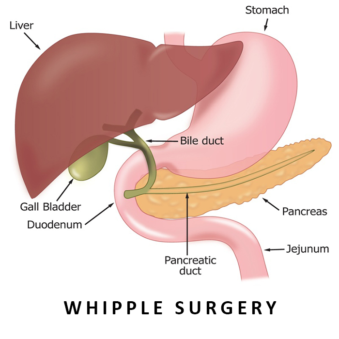 Whipple Surgery in Ahmedabad, Gujarat